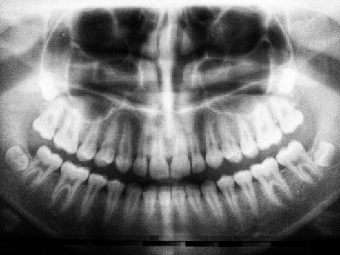 x-ray image of a set of healthy teeth and wisdom tooth