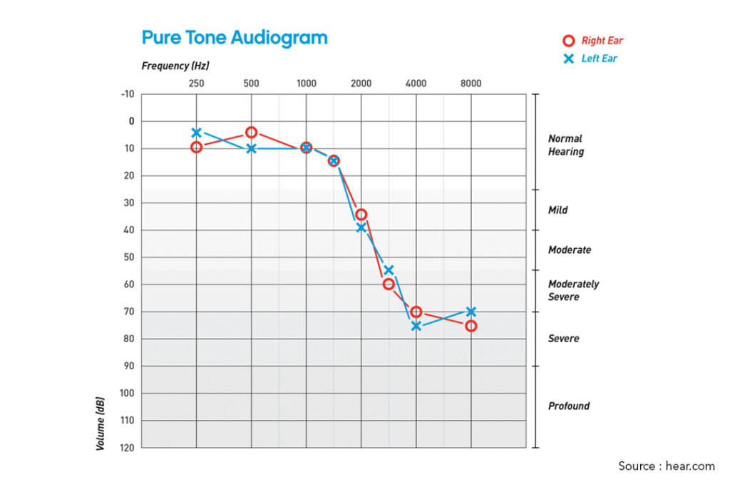 image of pure tone audiogram result in hearing test singapore