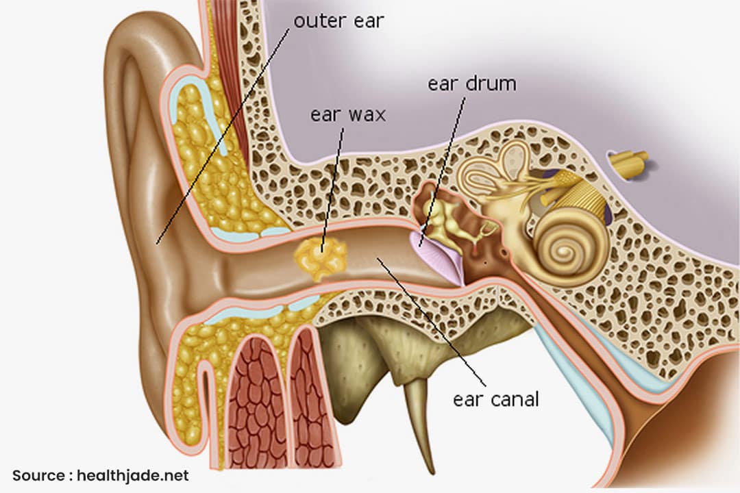 Hearing loss in Singapore Conductive Hearing Loss