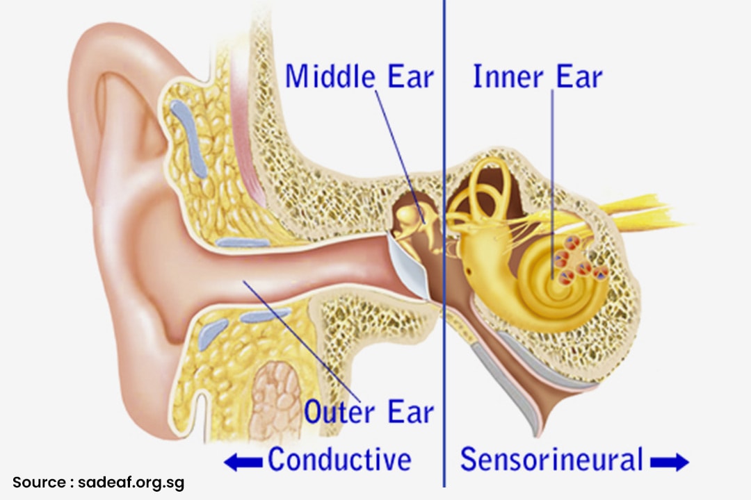 Hearing loss in Singapore Sensorineural Hearing Loss